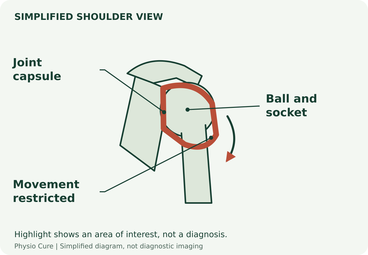 Simplified shoulder joint with a highlighted capsule surrounding the ball and socket, illustrating restriction rather than a tear.