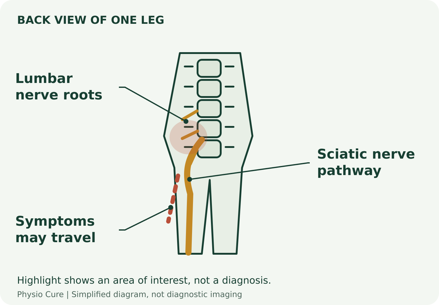 Simplified back view showing lumbar nerve roots joining a nerve pathway into one leg; the highlighted route illustrates possible symptoms, not a diagnosis.