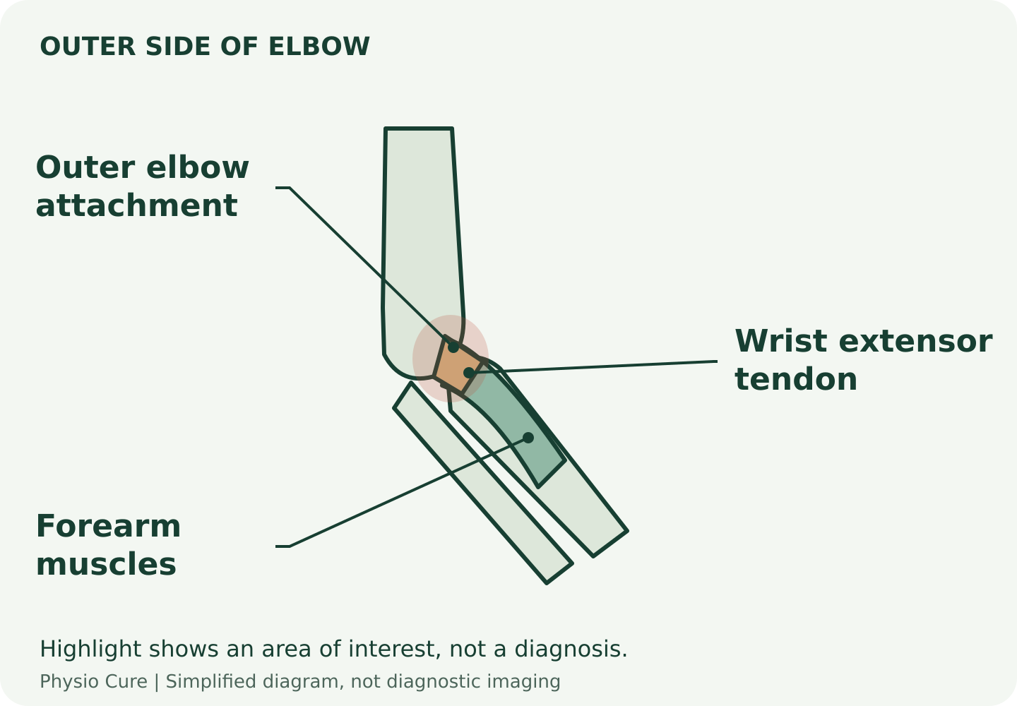 Simplified outer-elbow diagram showing the wrist-extensor tendon attachment and forearm muscles.